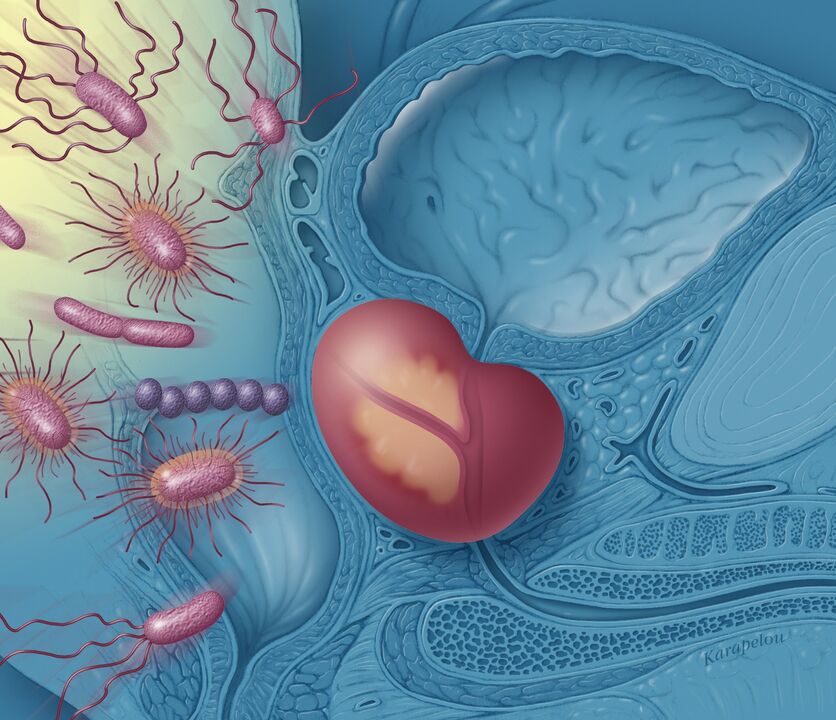 Prostatitis to men