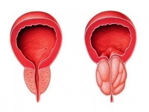 Healthy and inflamed prostate
