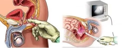 Instrumental diagnosis of prostatitis