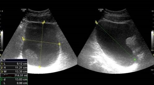 Signs of prostatitis for ultrasound
