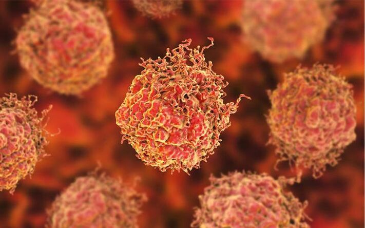 Prostate cancer cells